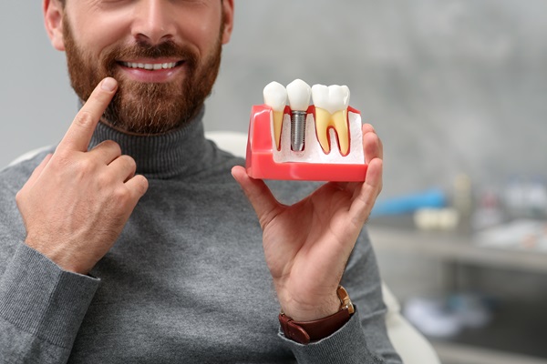 Dental Implants To Replace Missing Teeth