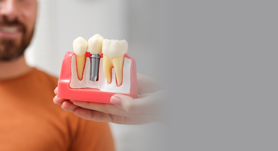 Dental Implants with Abutments and Crowns